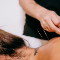 Acupuncture à l&rsquo;île Maurice : médecine chinoise, bien-être et où consulter